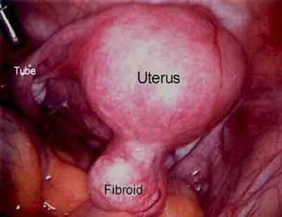 Fibroid